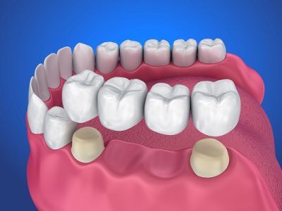 Implant-Bridge