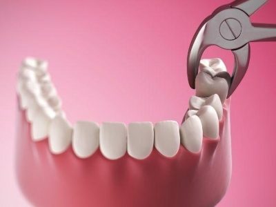 Wisdom-Teeth-Extracted