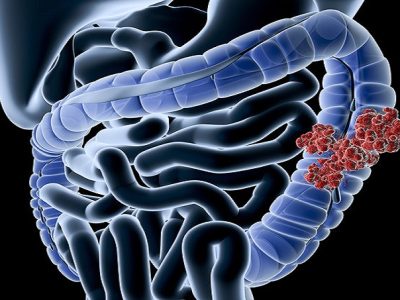 "Digital medical illustration: Perspective x-ray view of human colon with tumor. Anatomically correct. Isolated on black.For other cancer related-and general anatomy images, see:"