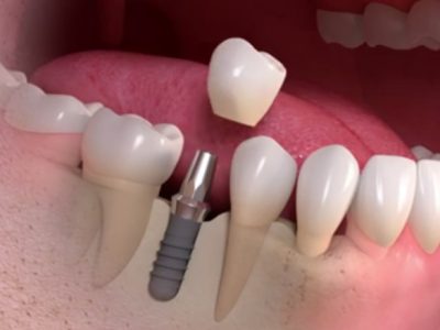 implants