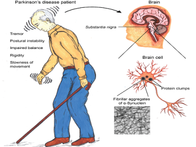 parkinsons