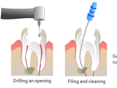 root-canal-treatment