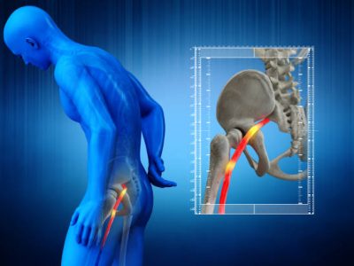 Pinched human sciatic nerve, anatomical vision. 3D Render.