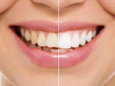 teeth-whitening